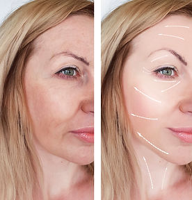 Dermal Fillers | LegacyHealthWellness